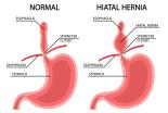 hernie_diaphragmatique_congenitale_hdc.jpg