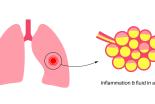 pneumopathie_interstitielle.jpg
