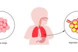 pneumopathie_interstitielle2.jpg