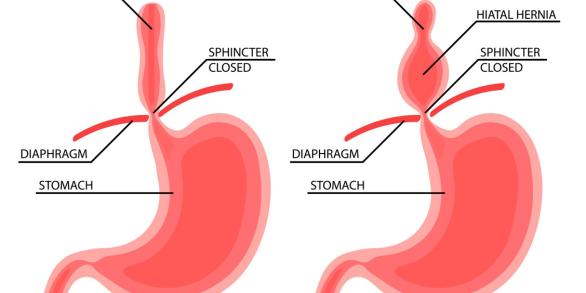 hernie_diaphragmatique.jpg