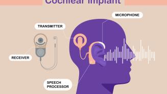 coupe_implant_coch_face.jpg