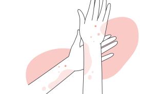 eczema.jpg
