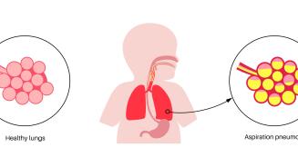 pneumopathie_interstitielle2.jpg