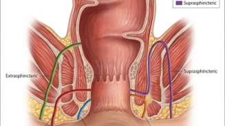 Classification des fistules (péri-)anales